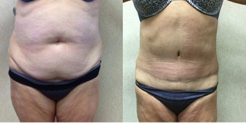 before and after results of a female patient