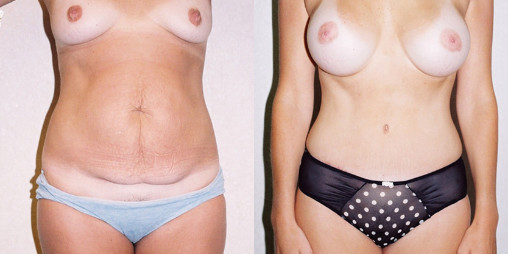 before and after results of a mommy makeover