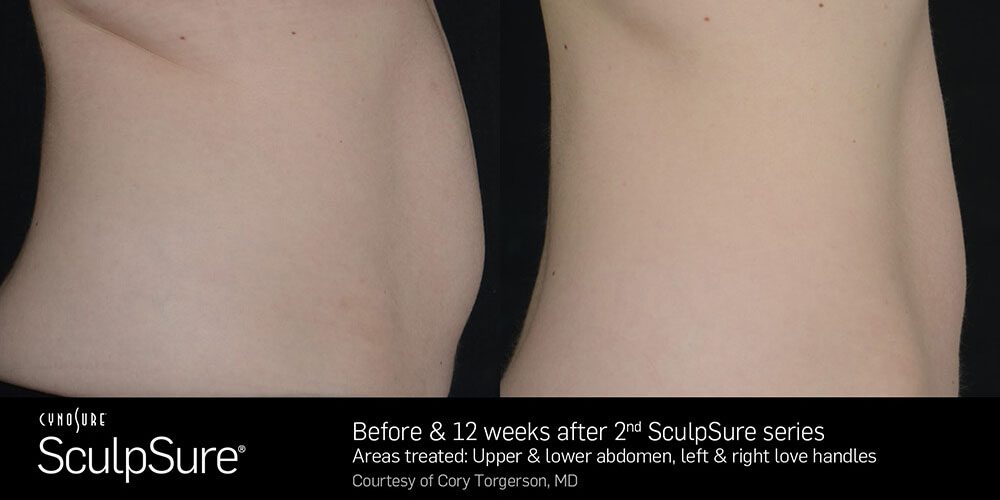 Sculpsure before and after results leftside view