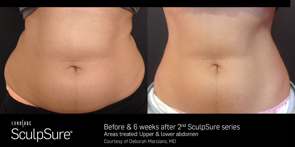 Sculpsure before and after results frontview