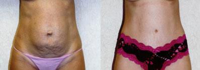tummy tuck specialist North Orange County