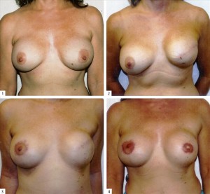 breast reconstruction surgery
