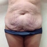 Abdominoplasty 01 Before Thumbnail Photo