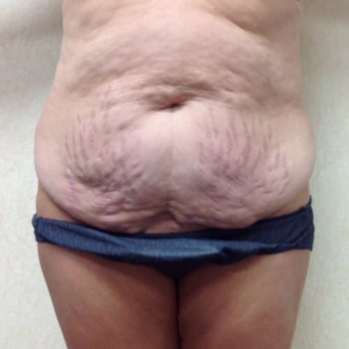 Abdominoplasty 01 Before Photo