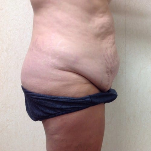 Abdominoplasty 01 Before Photo