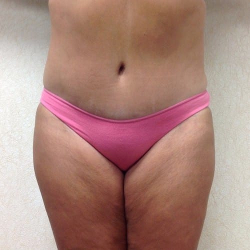 Abdominoplasty 01 After Photo