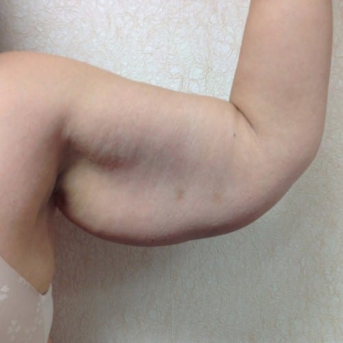 Brachioplasty 01 Before Photo