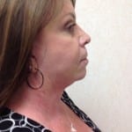 Facelift 01 Before Thumbnail Photo