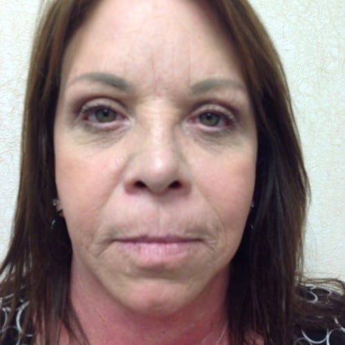 Facelift 01 Before Photo