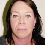 Facelift 01 After Thumbnail Photo