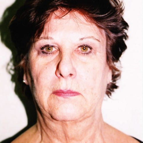 Facelift 02 Before Photo