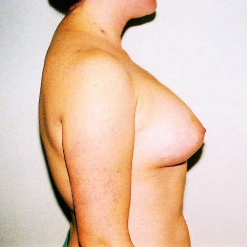 Breast Augmentation 04 After Photo
