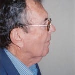 Facelift 03 Before Thumbnail Photo