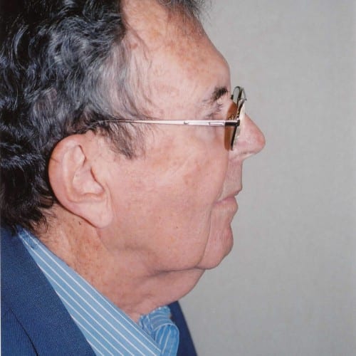 Facelift 03 Before Photo