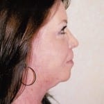 Facelift 01 After Thumbnail Photo