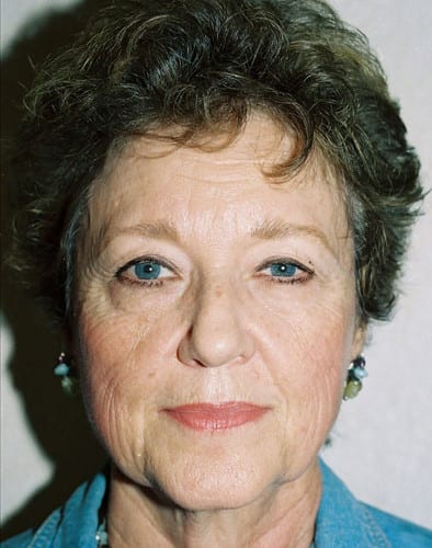 Blepharoplasty 01 Before Photo