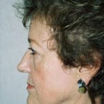 Blepharoplasty 01 Before Thumbnail Photo