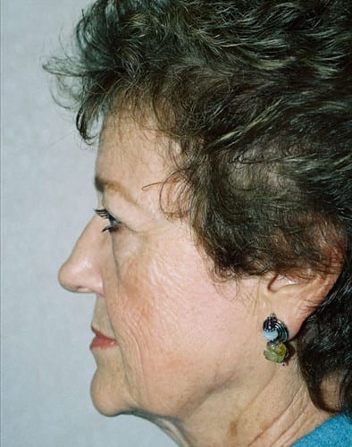 Blepharoplasty 01 Before Photo