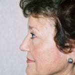 Blepharoplasty 01 After Thumbnail Photo