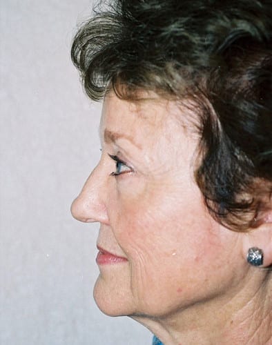 Blepharoplasty 01 After Photo