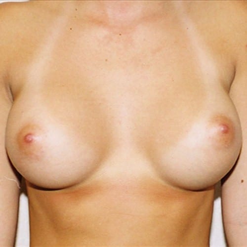 Breast Augmentation 06 After Photo