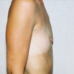 Breast Augmentation 07 Before Thumbnail Photo