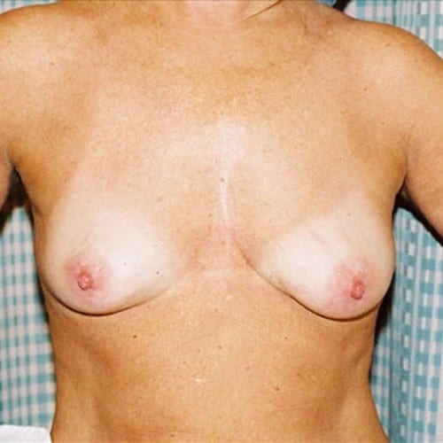 Breast Augmentation 08 Before Photo