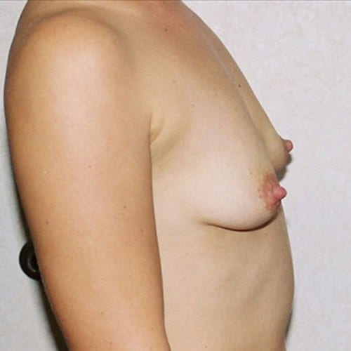 Breast Augmentation 09 Before Photo