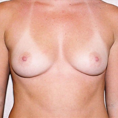Breast Augmentation 11 Before Photo