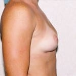 Breast Augmentation 11 Before Thumbnail Photo