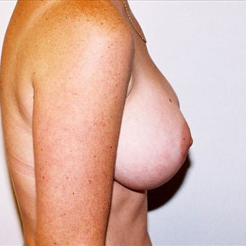 Breast Augmentation 12 After Photo