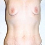 Breast Augmentation 13 Before Thumbnail Photo