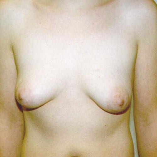 Breast Lift 02 Before Photo
