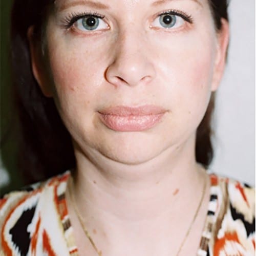 Chin Augmentation 01 Before Photo