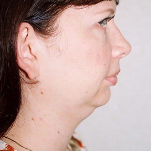 Chin Augmentation 01 Before Photo