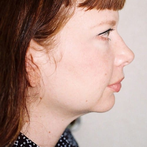 Chin Augmentation 01 After Photo