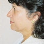 Facelift 09 Before Thumbnail Photo