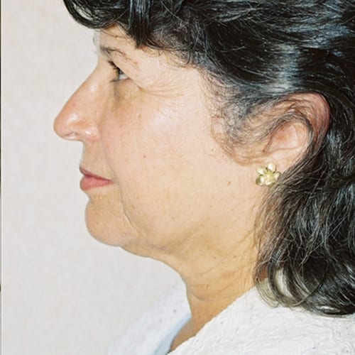 Facelift 09 Before Photo