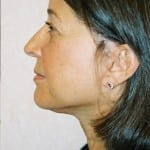 Facelift 09 After Thumbnail Photo