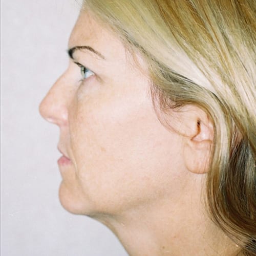 Facelift 11 Before Photo