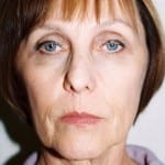 Facelift 12 Before Thumbnail Photo