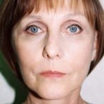 Facelift 12 After Thumbnail Photo