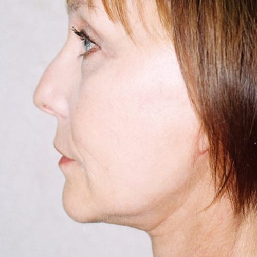 Facelift 12 After Photo