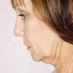 Facelift 12 Before Thumbnail Photo