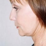 Facelift 12 After Thumbnail Photo