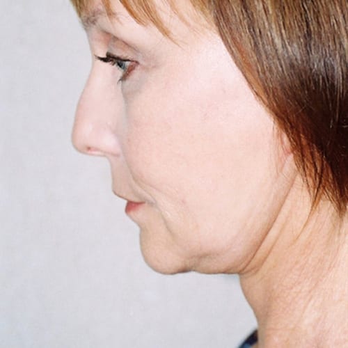 Facelift 12 After Photo