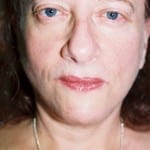 Facelift 13 After Thumbnail Photo