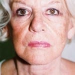 Facelift 15 After Thumbnail Photo