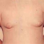 Male Cosmetic Surgery 07 Before Thumbnail Photo