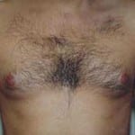 Male Cosmetic Surgery 08 Before Thumbnail Photo